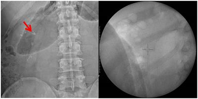 Synchronized extracorporeal shockwave lithotripsy may still affect the heart: a case report of perioperative ST-segment elevation myocardial infarction